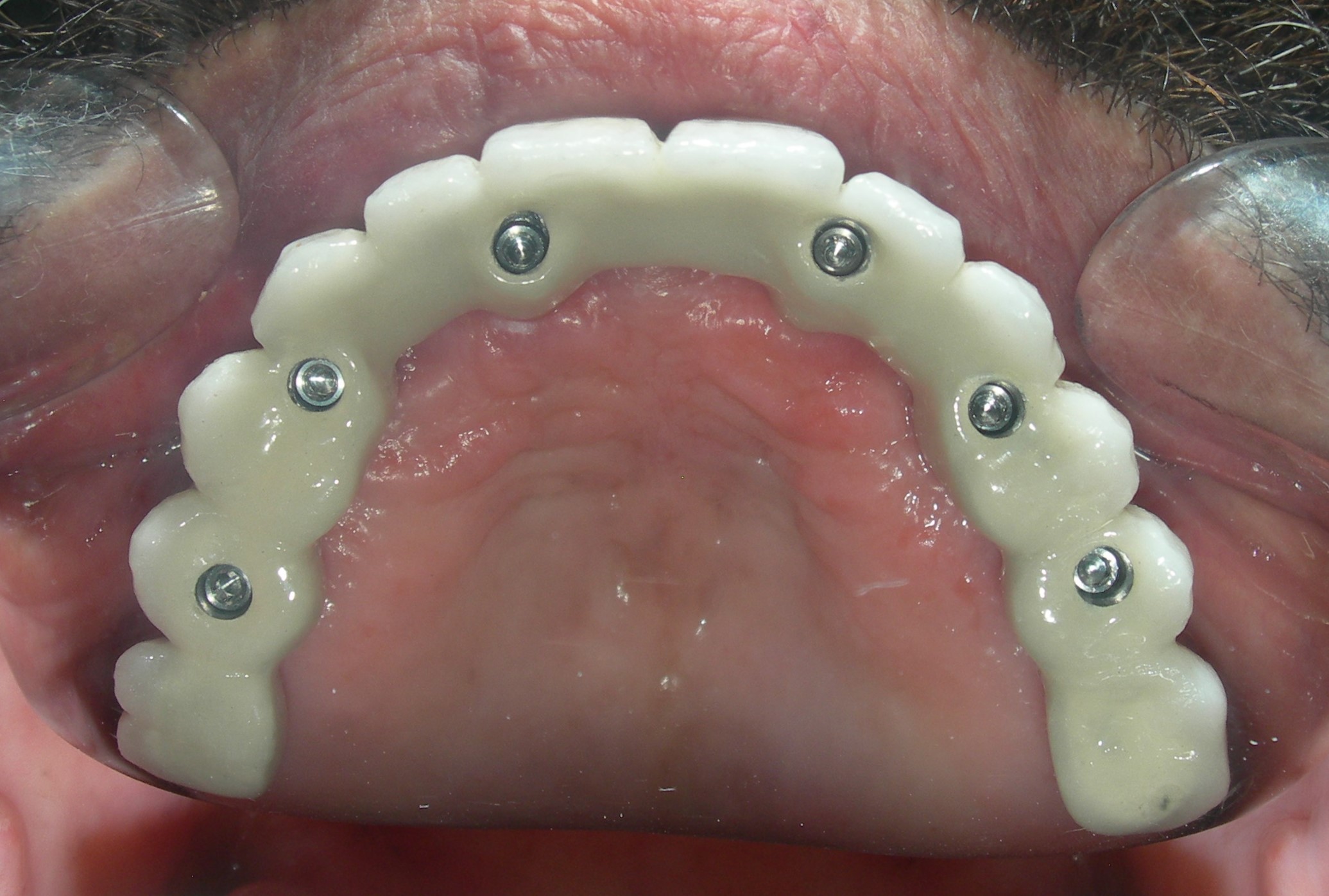 İmplant Vidalı Sistem Sonrası